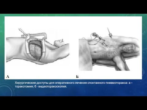 Хирургические доступы для оперативного лечения спонтанного пневмоторакса: а – торакотомия; б - видеоторакоскопия.