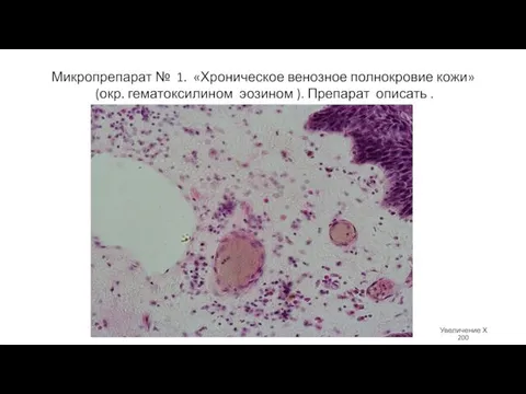 Микропрепарат № 1. «Хроническое венозное полнокровие кожи» (окр. гематоксилином эозином ).