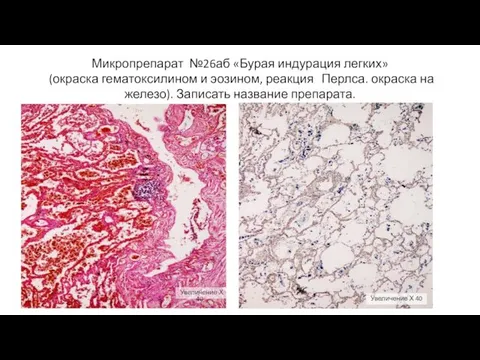 Микропрепарат №26аб «Бурая индурация легких» (окраска гематоксилином и эозином, реакция Перлса.