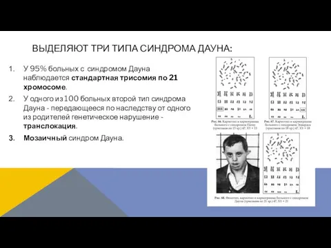 У 95% больных с синдромом Дауна наблюдается стандартная трисомия по 21