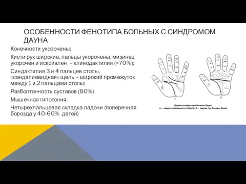 Конечности укорочены; Кисти рук широкие, пальцы укорочены, мизинец укорочен и искривлен