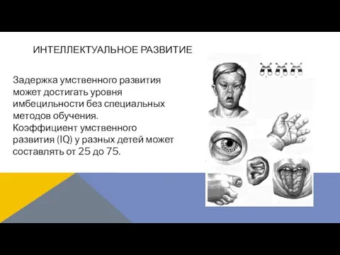 Задержка умственного развития может достигать уровня имбецильности без специальных методов обучения.