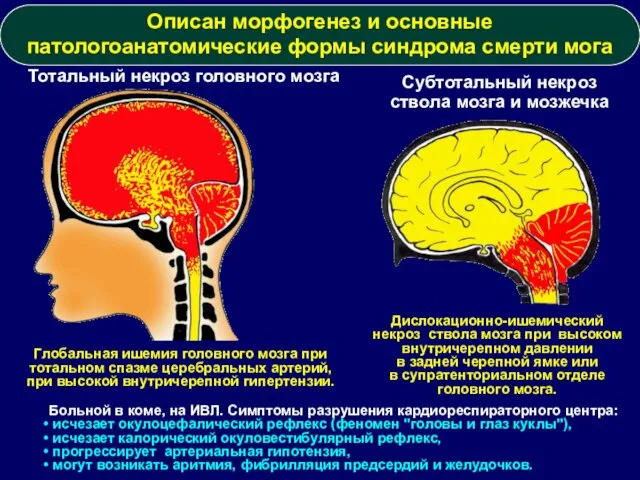 Дислокационно-ишемический некроз ствола мозга при высоком внутричерепном давлении в задней черепной