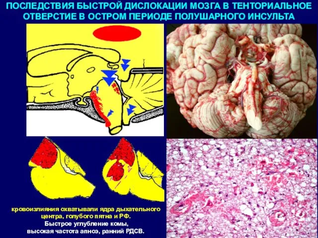 ПОСЛЕДСТВИЯ БЫСТРОЙ ДИСЛОКАЦИИ МОЗГА В ТЕНТОРИАЛЬНОЕ ОТВЕРСТИЕ В ОСТРОМ ПЕРИОДЕ ПОЛУШАРНОГО