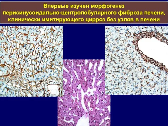 Впервые изучен морфогенез перисинусоидально-центролобулярного фиброза печени, клинически имитирующего цирроз без узлов в печени