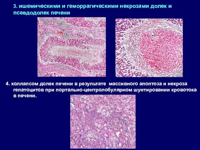 3. ишемическими и геморрагическими некрозами долек и псевдодолек печени 4. коллапсом