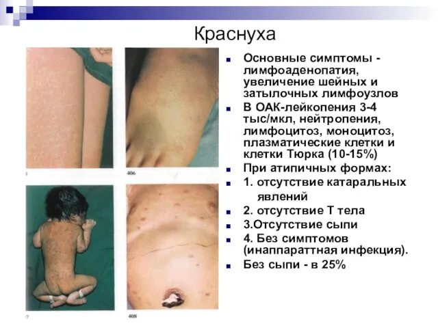 Краснуха Основные симптомы - лимфоаденопатия, увеличение шейных и затылочных лимфоузлов В