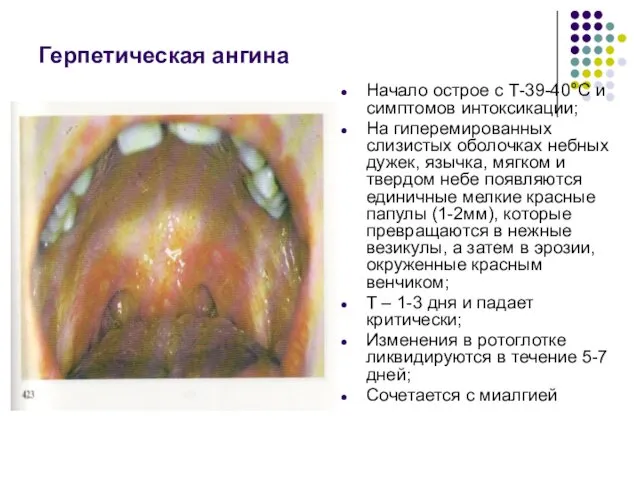 Герпетическая ангина Начало острое с Т-39-40°С и симптомов интоксикации; На гиперемированных