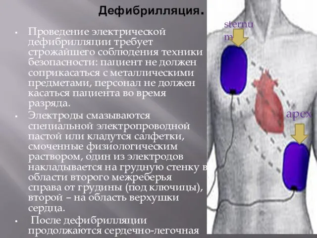 Дефибрилляция. Проведение электрической дефибрилляции требует строжайшего соблюдения техники безопасности: пациент не