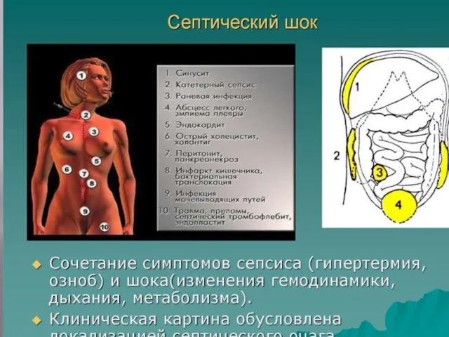 Септический шок