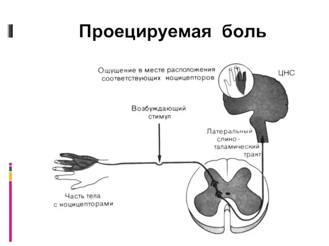 Проецируемая боль