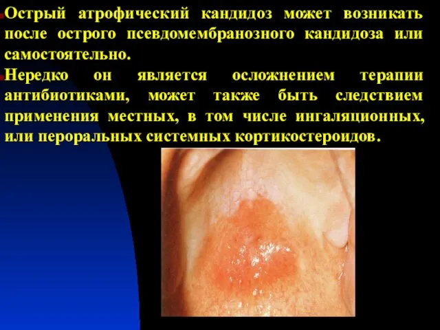Острый атрофический кандидоз может возникать после острого псевдомембранозного кандидоза или самостоятельно.