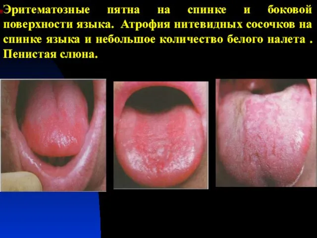 Эритематозные пятна на спинке и боковой поверхности языка. Атрофия нитевидных сосочков