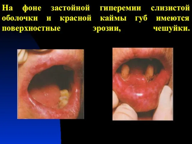 На фоне застойной гиперемии слизистой оболочки и красной каймы губ имеются поверхностные эрозии, чешуйки.