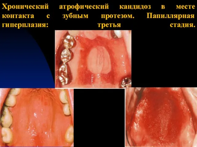 Хронический атрофический кандидоз в месте контакта с зубным протезом. Папиллярная гиперплазия: третья стадия.
