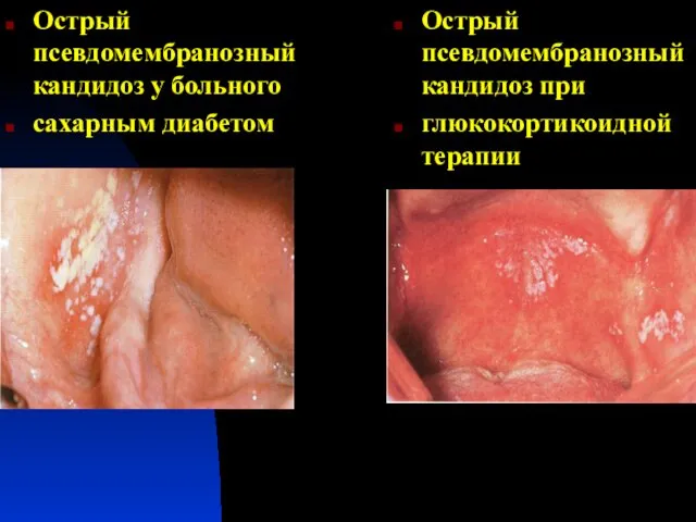 Острый псевдомембранозный кандидоз у больного сахарным диабетом Острый псевдомембранозный кандидоз при глюкокортикоидной терапии