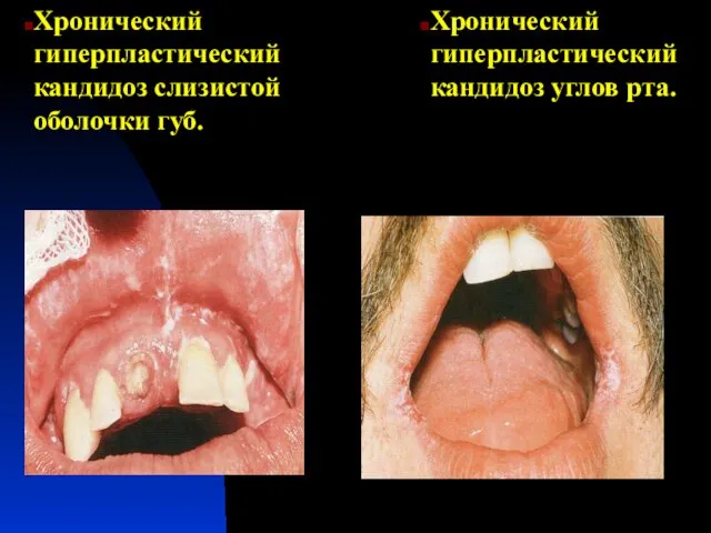 Хронический гиперпластический кандидоз слизистой оболочки губ. Хронический гиперпластический кандидоз углов рта.