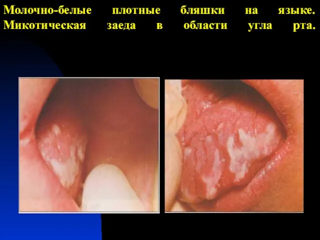 Молочно-белые плотные бляшки на языке. Микотическая заеда в области угла рта.