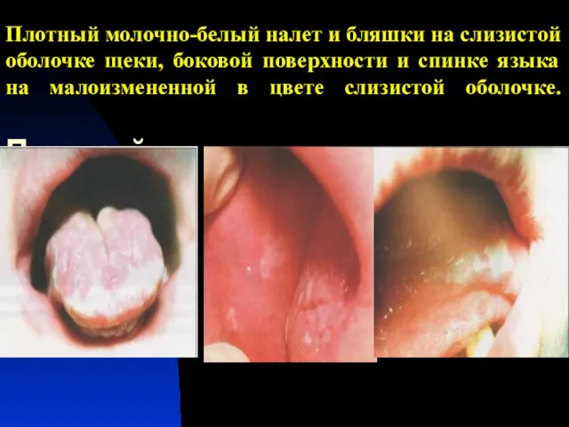 Плотный молочно-белый налет и бляшки на слизистой оболочке щеки, боковой поверхности