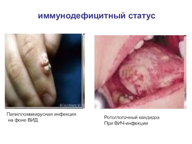 иммунодефицитный статус Папилломавирусная инфекция на фоне ВИД Ротоглоточный кандидоз При ВИЧ-инфекции