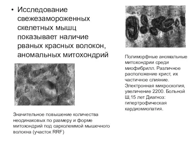 Исследование свежезамороженных скелетных мышц показывает наличие рваных красных волокон, аномальных митохондрий