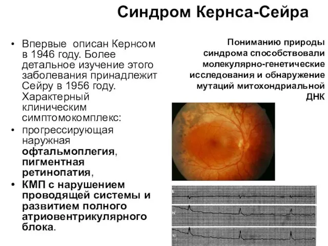 Синдром Кернса-Сейра Впервые описан Кернсом в 1946 году. Более детальное изучение