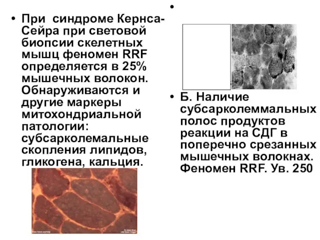 При синдроме Кернса-Сейра при световой биопсии скелетных мышц феномен RRF определяется