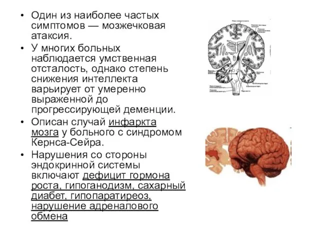 Один из наиболее частых симптомов — мозжечковая атаксия. У многих больных