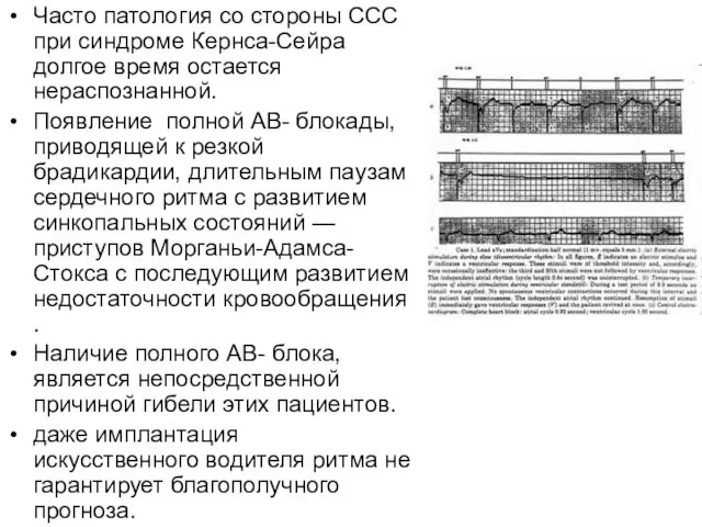 Часто патология со стороны ССС при синдроме Кернса-Сейра долгое время остается