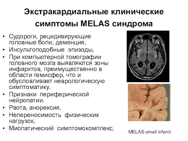 Экстракардиальные клинические симптомы MELAS синдрома Судороги, рецидивирующие головные боли, деменция, Инсультоподобные