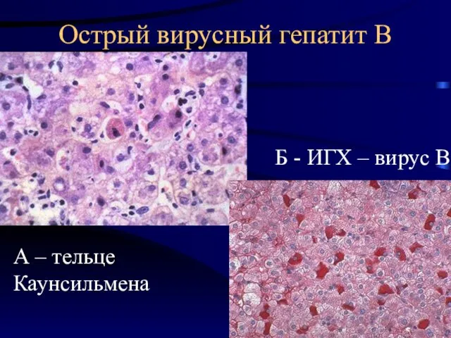 Острый вирусный гепатит В А – тельце Каунсильмена Б - ИГХ – вирус В