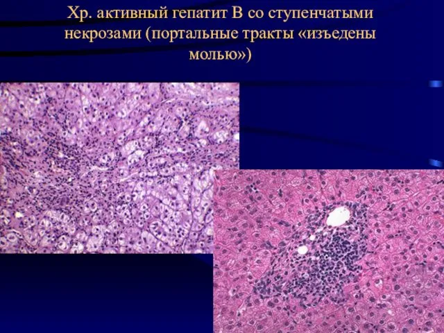 Хр. активный гепатит В со ступенчатыми некрозами (портальные тракты «изъедены молью»)