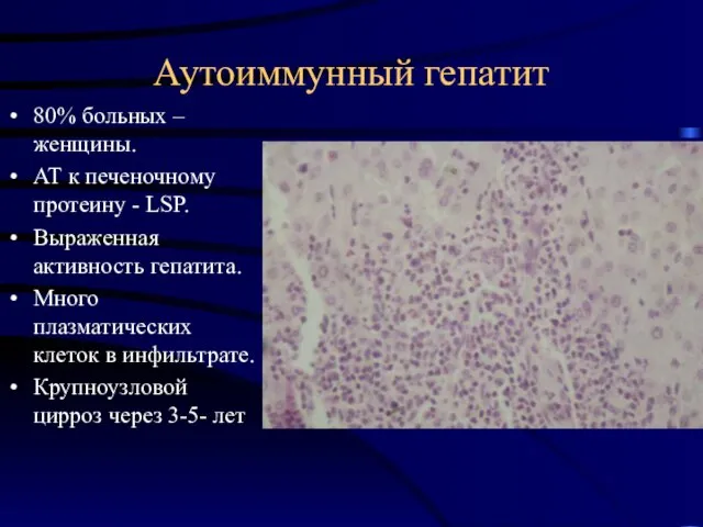 Аутоиммунный гепатит 80% больных – женщины. АТ к печеночному протеину -