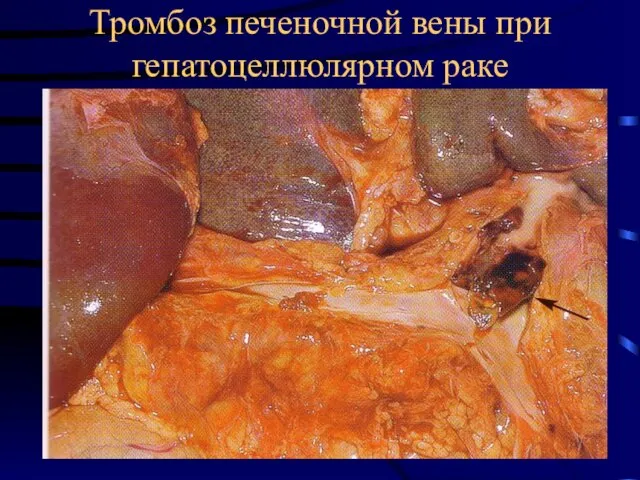 Тромбоз печеночной вены при гепатоцеллюлярном раке