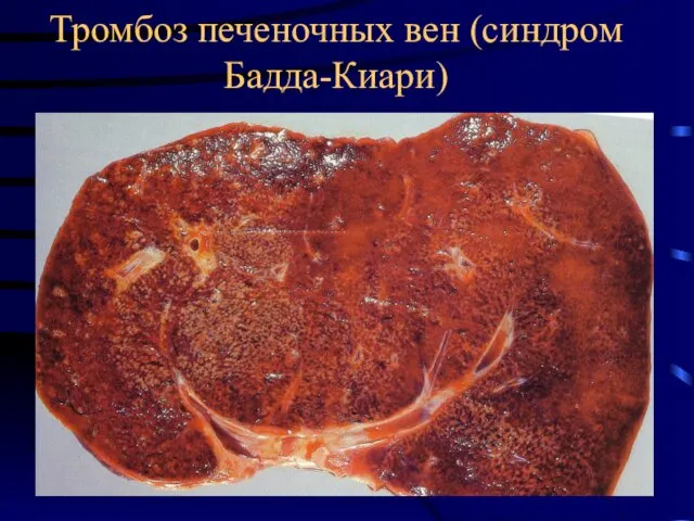 Тромбоз печеночных вен (синдром Бадда-Киари)