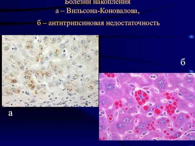 Болезни накопления а – Вильсона-Коновалова, б – антитрипсиновая недостаточность а б