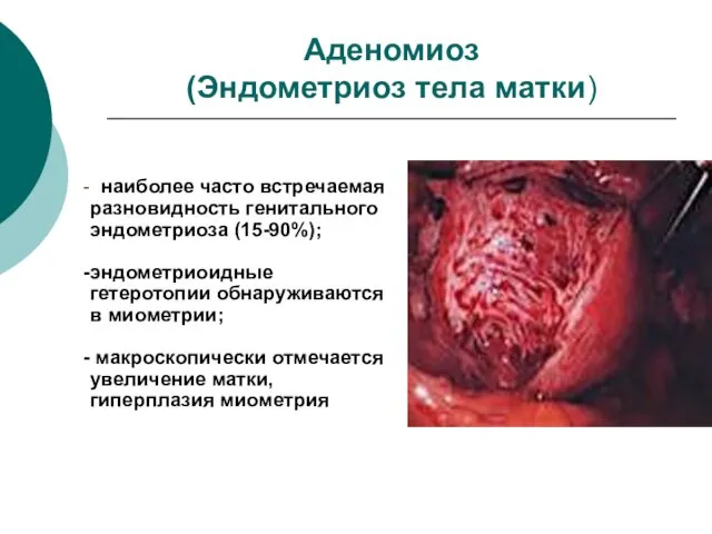 Аденомиоз (Эндометриоз тела матки) наиболее часто встречаемая разновидность генитального эндометриоза (15-90%);