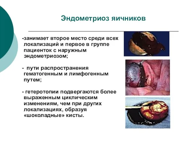 Эндометриоз яичников занимает второе место среди всех локализаций и первое в