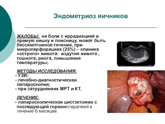 Эндометриоз яичников ЖАЛОБЫ: на боли с иррадиацией в прямую кишку и