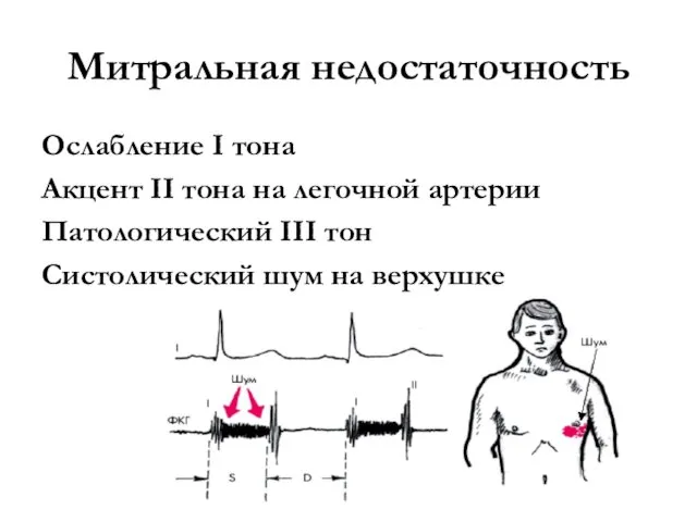 Митральная недостаточность Ослабление I тона Акцент II тона на легочной артерии