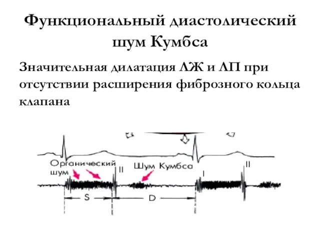 Функциональный диастолический шум Кумбса Значительная дилатация ЛЖ и ЛП при отсутствии расширения фиброзного кольца клапана