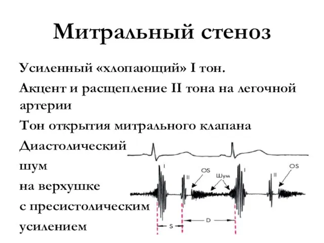 Митральный стеноз Усиленный «хлопающий» I тон. Акцент и расщепление II тона