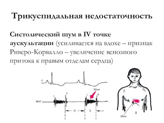 Трикуспидальная недостаточность Систолический шум в IV точке аускультации (усиливается на вдохе