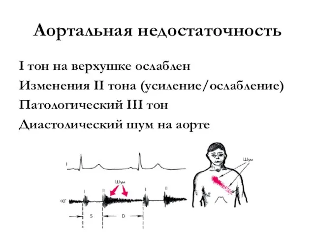 Аортальная недостаточность I тон на верхушке ослаблен Изменения II тона (усиление/ослабление)