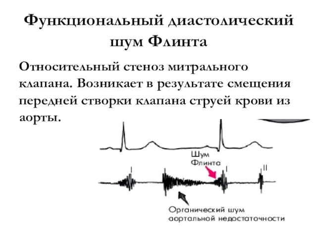 Функциональный диастолический шум Флинта Относительный стеноз митрального клапана. Возникает в результате