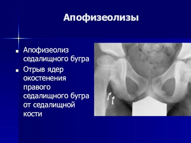 Апофизеолизы Апофизеолиз седалищного бугра Отрыв ядер окостенения правого седалищного бугра от седалищной кости