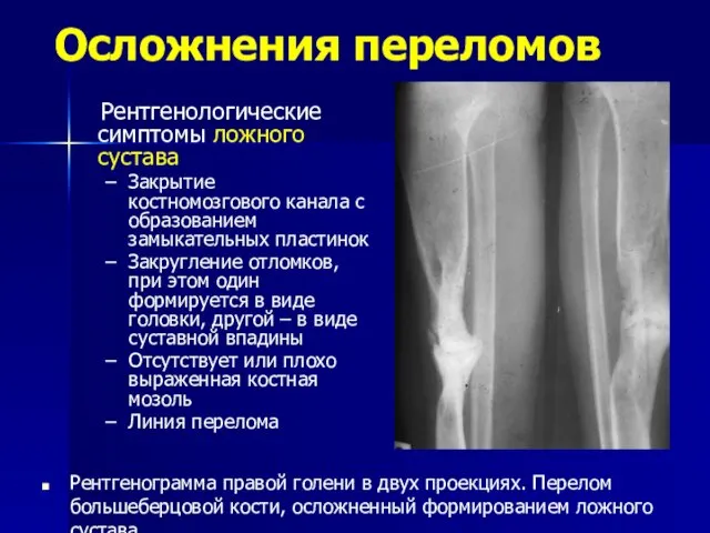 Осложнения переломов Рентгенологические симптомы ложного сустава Закрытие костномозгового канала с образованием