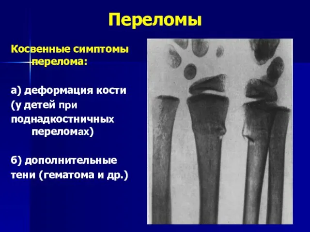 Переломы Косвенные симптомы перелома: а) деформация кости (у детей при поднадкостничных