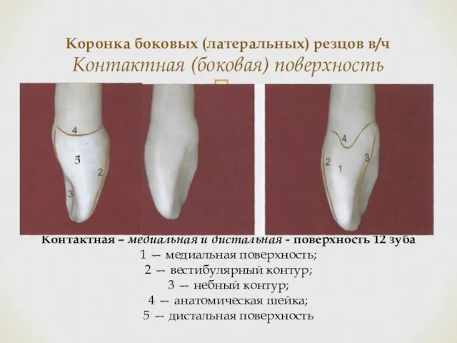 Коронка боковых (латеральных) резцов в/ч Контактная (боковая) поверхность Контактная – медиальная