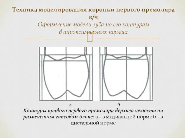 Контуры правого первого премоляра верхней челюсти на размеченном гипсовом блоке: а